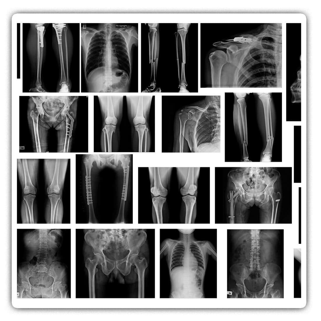 2 x Square Stickers 10 cm - X-Ray Bone Fracture Plate Pins  #43026